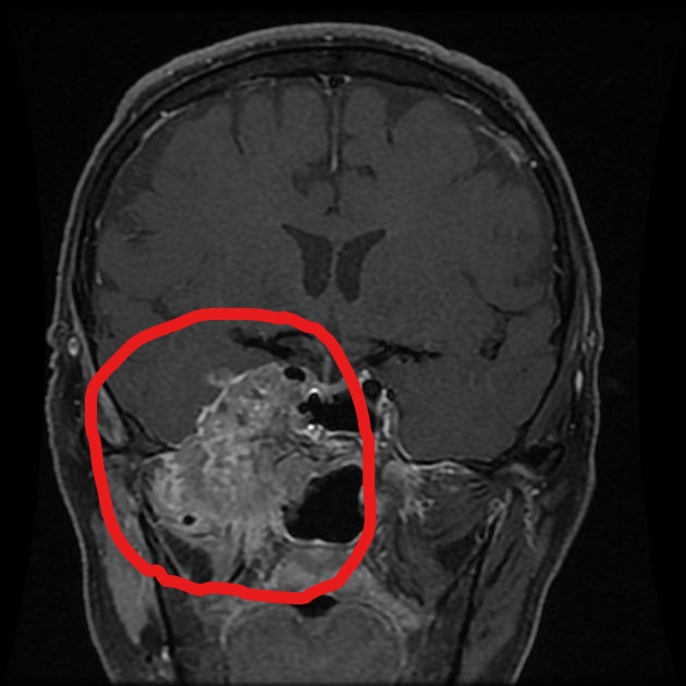 File:Nasopharyngeal Carcinoma- MRI T1 (2).jpg