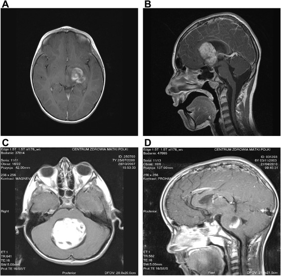 Location of pilocytic astrocytoma on contrast MRI. a cerebral hemispheric tumor, b optic tract and hypothalamic tumor, c cerebellar tumor, and d brainstem tumor.[1]