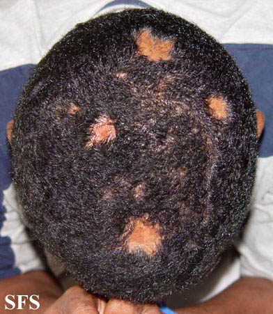 Pseudopelade. With permission from Dermatology Atlas.[3]