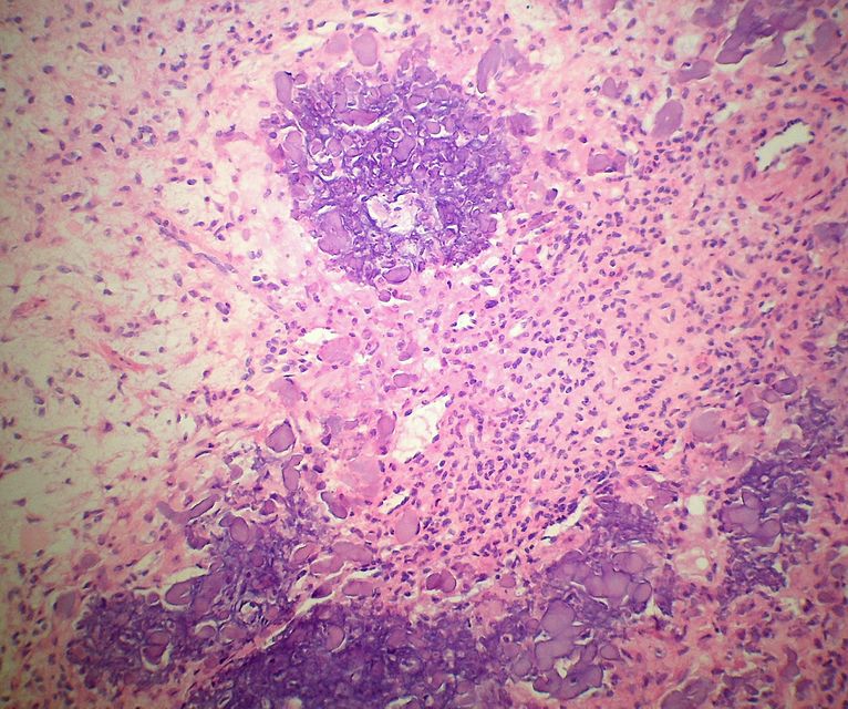 Histopathology specimen of a chondromyxoid fibroma showing focus of amorphous calcification