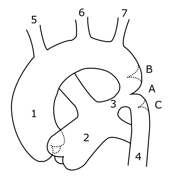 Schematic drawing of alternative locations of a coarctation of the aorta, relative to the ductus arteriosus. A: ductal coarctation, B: preductal coarctation, C: postductal coarctation. 1: Aorta ascendens, 2: Arteria pulmonalis, 3: Ductus arteriosus, 4: Aorta descendens, 5: Trunchus brachiocephalicus, 6: Arteria carotis communis sinister, 7: Arteria subclavia sinister
