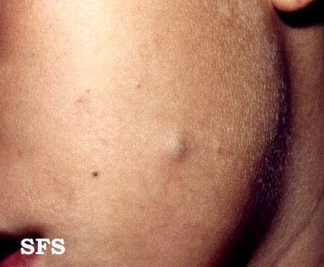 Epidermoid cyst. Adapted from Dermatology Atlas.[4]