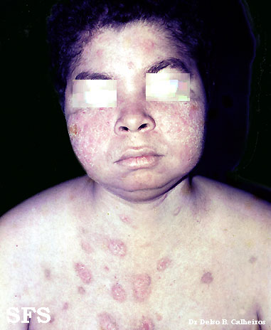 Pemphigus foliaceus-localized form. With permission from Dermatology Atlas.[4]