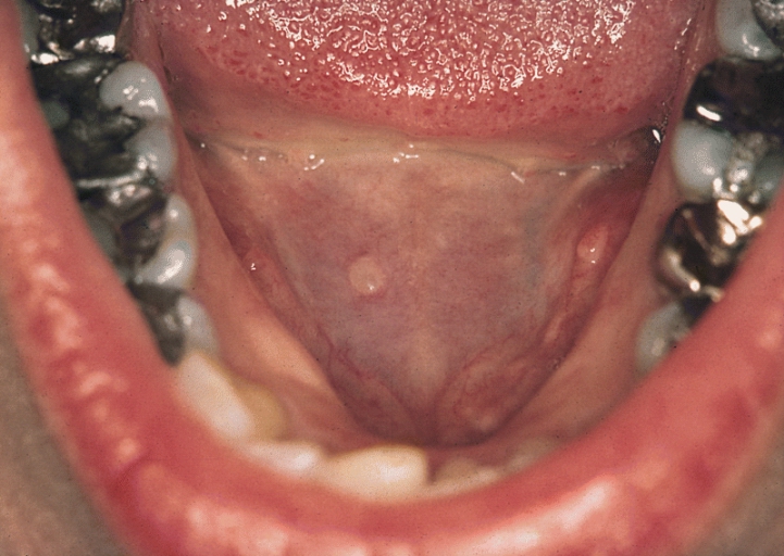 SALIVARY GLANDS: SUPERFICIAL MUCOCELE. This mucocele in the floor of the mouth has a translucent appearance because the mucosa overlying it is very thin.