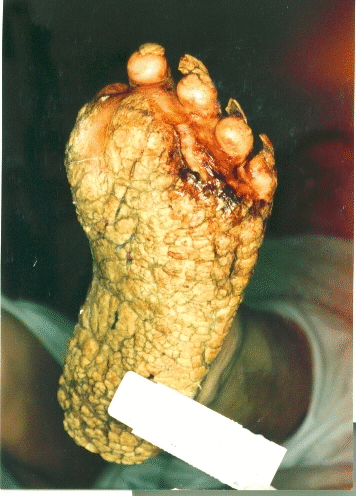 File:Plantar keratosis in Cowden syndrome.gif