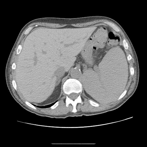 Splenomegaly CT - wikidoc