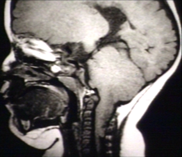 Brain: Arnold Chiari Type II with Medullary Spur and Kink (MRI)