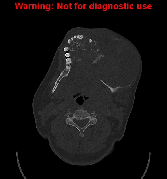 Axial Bone Window ameloblastoma[2]