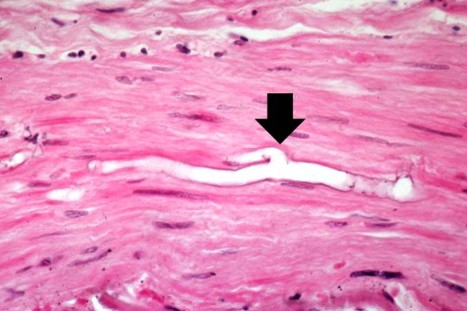 This is a higher-power photomicrograph of just the wall of the carotid artery. Note the ribbon-like clear structure with roughly parallel walls (non-septate hyphae) and right-angle branching (arrow). This is the Mucor organism.