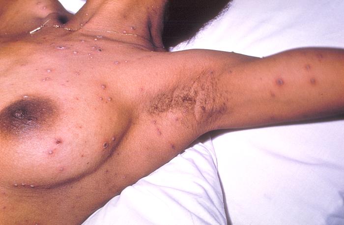 Chickenpox lesions on the skin of this patient's left breast and arm on day 6 of the illness. From Public Health Image Library (PHIL). [3]