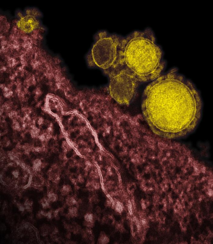 TEM reveals ultrastructural details exhibited by five spherical-shaped Middle East Respiratory Syndrome Coronavirus (MERS-CoV) virions, which were colorized yellow. From Public Health Image Library (PHIL). [6]