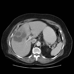 69 year old women with two month history of right upper quadrant pain . Large heterogenous, hypovascular liver mass which abuts an abnormal - appearing gallbladder