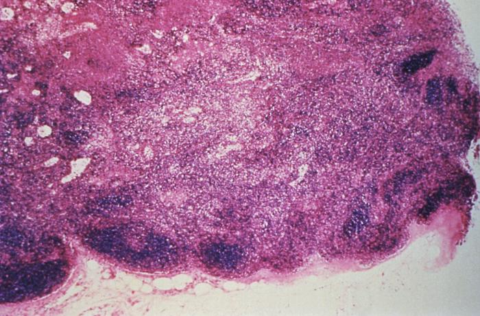 This is micrographic study of a lymph node from a Hantavirus pulmonary syndrome (HPS) patient. From Public Health Image Library (PHIL). [1]