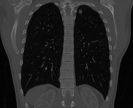 Chest CT scan with lung metastatis 3.jpg