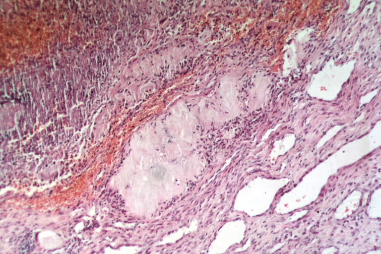 Skin: Tophus: Micro med mag H&E easily recognized uric acid deposit lesion from elbow