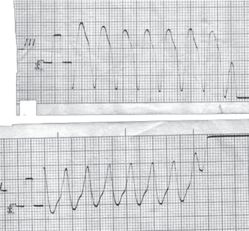 File:Pulseless ventriculat tachycardia.png