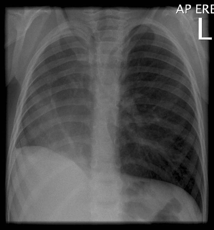 Chest x-ray: Scimitar Syndrome (Image courtesy of Dr Donna D'Souza)