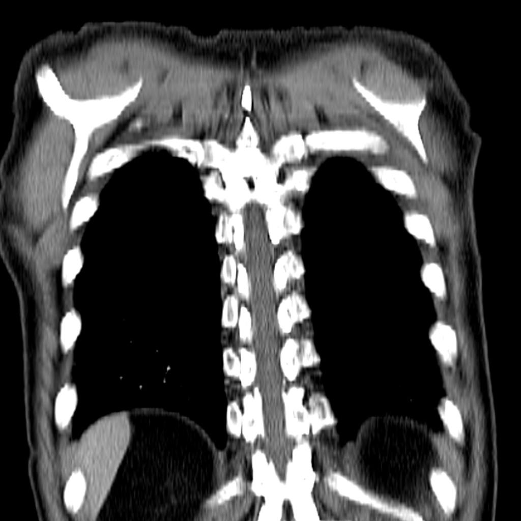 File:Small-cell-lung-cancer.jpg