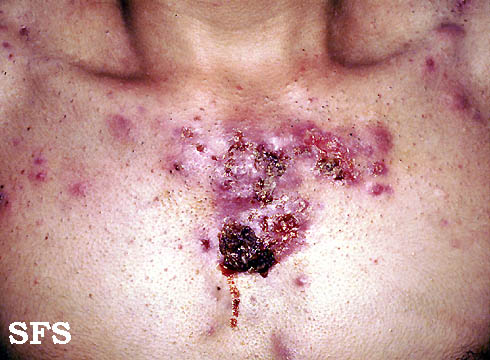 Acne necrotica. Adapted from [http://www.atlasdermatologico.com.br/disease.jsf?diseaseId=4