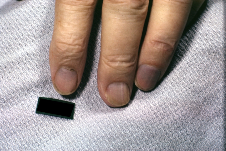 Acrocyanosis: Gross, excellent example of cyanotic nail beds