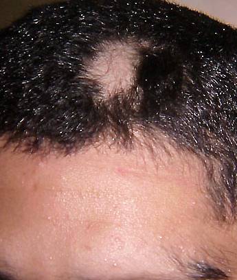 File:Alopecia areata 09.png