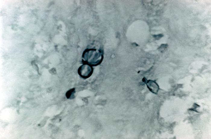 Note the histopathologic changes seen in blastomycosis due to Blastomyces dermatitidis using methenamine silver stain. From Public Health Image Library (PHIL). [26]