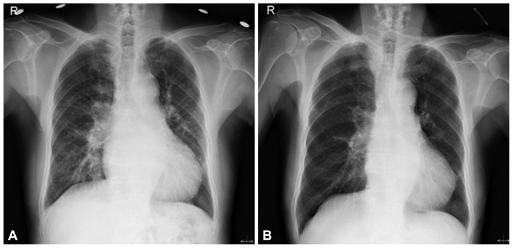 Initial chest X-ray shows cardiomegaly. CT ratio was 0.59. Pulmonary edema in both lungs without pleural effusion can be seen (