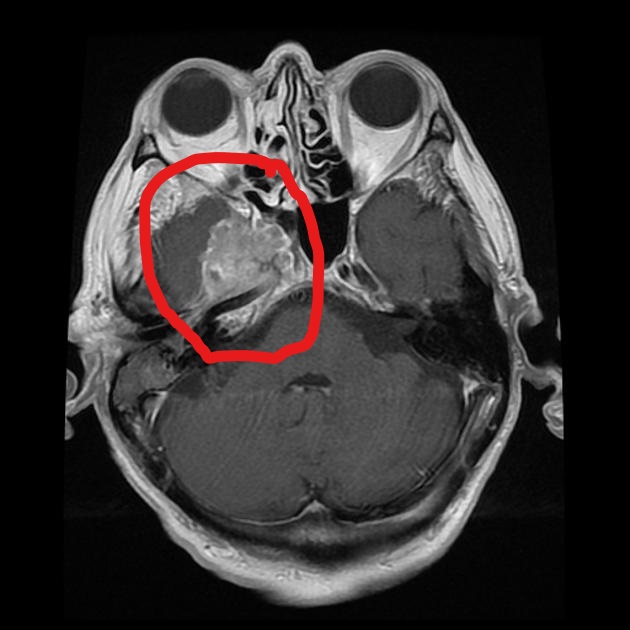 File:Nasopharyngeal carcinoma MRI.jpg