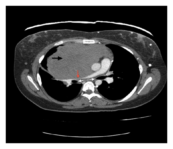 CT scan of the chest with contrast reveals a large lobulated anterior mediastinal solid mass (black arrow) with extension into the right hemithorax and the right atrium. There is displacement of the great vessels into the left hemithorax with significant mass effect on the right upper lobe. The tumor causes compression of the right pulmonary artery (red arrow) and right and left mainstem bronchi (white arrows).[2]