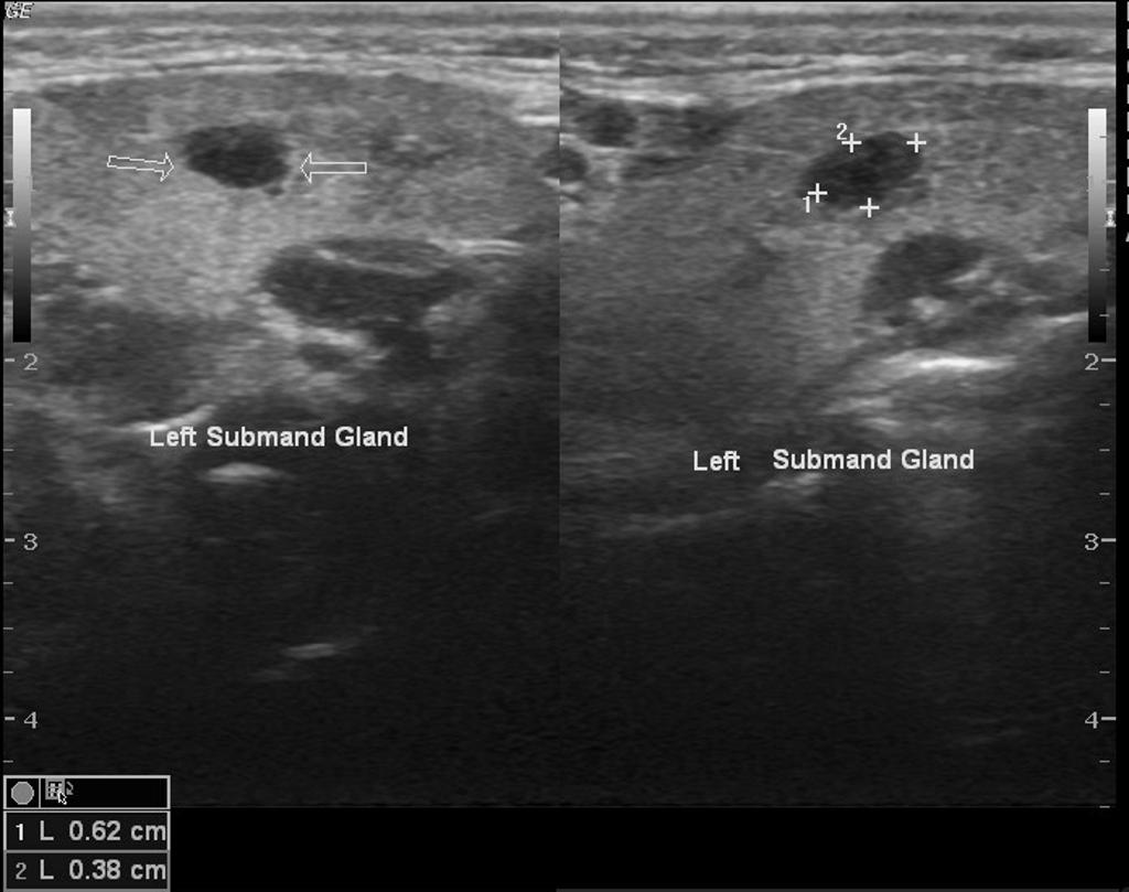 Ultrasound showing submandibular gland lesion-oncocytoma[7]