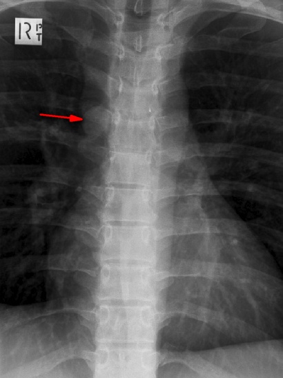 A young patient was involved in a trauma. A supine thoracic spine film demonstrates a rounded opacity in the right mediastinum, just superior to the right main bronchus (arrow). This opacity is a distended azygous vein, and it collapses when the patient is erect (erect chest xray). The azygous vein is a normal structure which may be distended in the supine position, right heart failure, inferior vena cava obstruction, and portosystemic shunting.