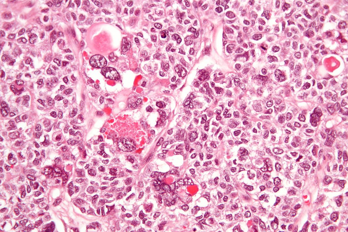 File:1200px-Juvenile granulosa cell tumour - very high mag.jpg