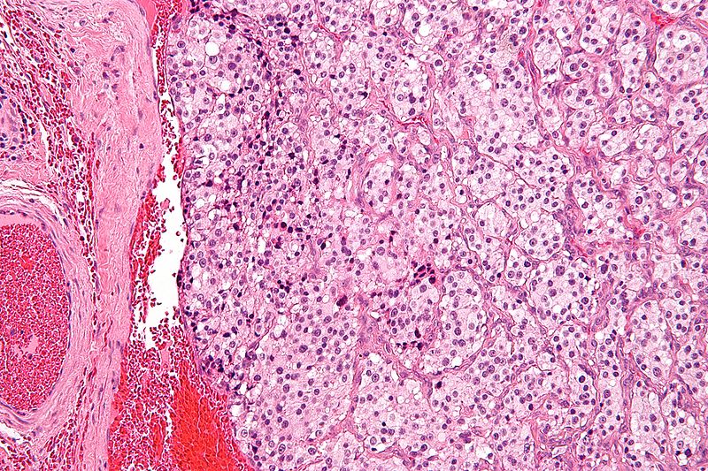 Carotid body tumor higher magnification[11]