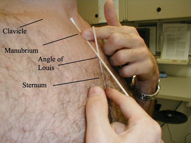 The wooden Q-tips highlight the different slopes of the sternum and manubrium.