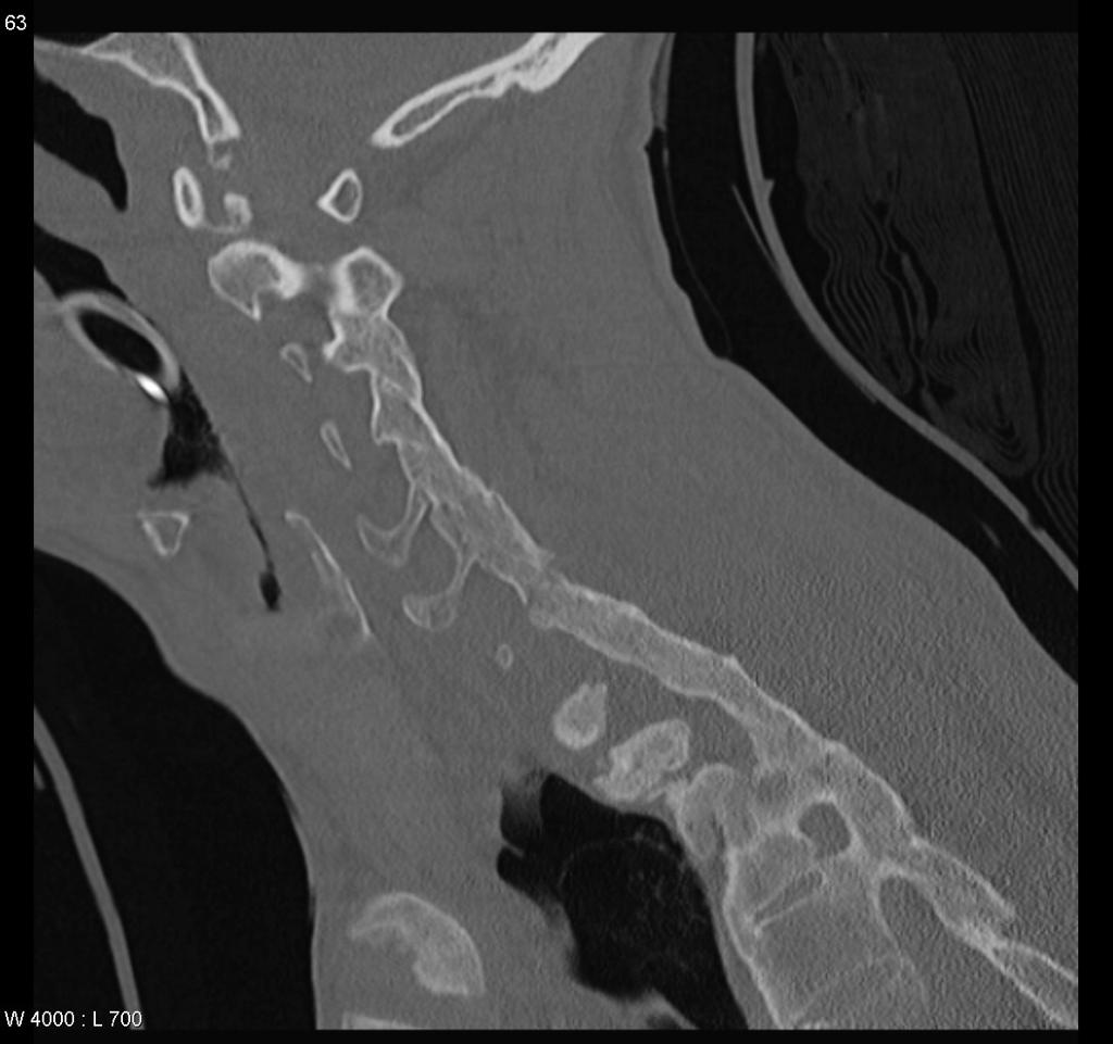 File:Ankylosing-spondylitis-and-chalk-fracture.jpg
