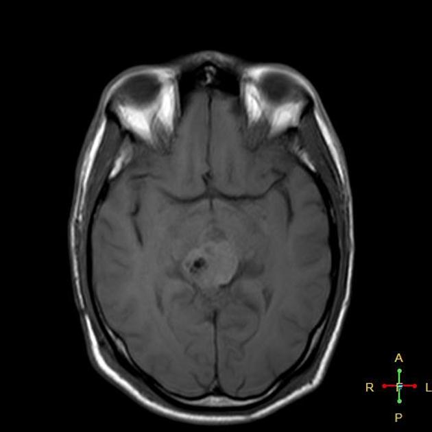 MRI showing Axial T1 image of germinoma of CNS[7]
