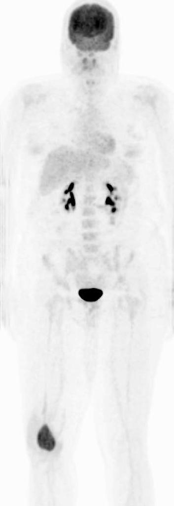 File:Bone scan giant-cell-tumour-femur.jpg
