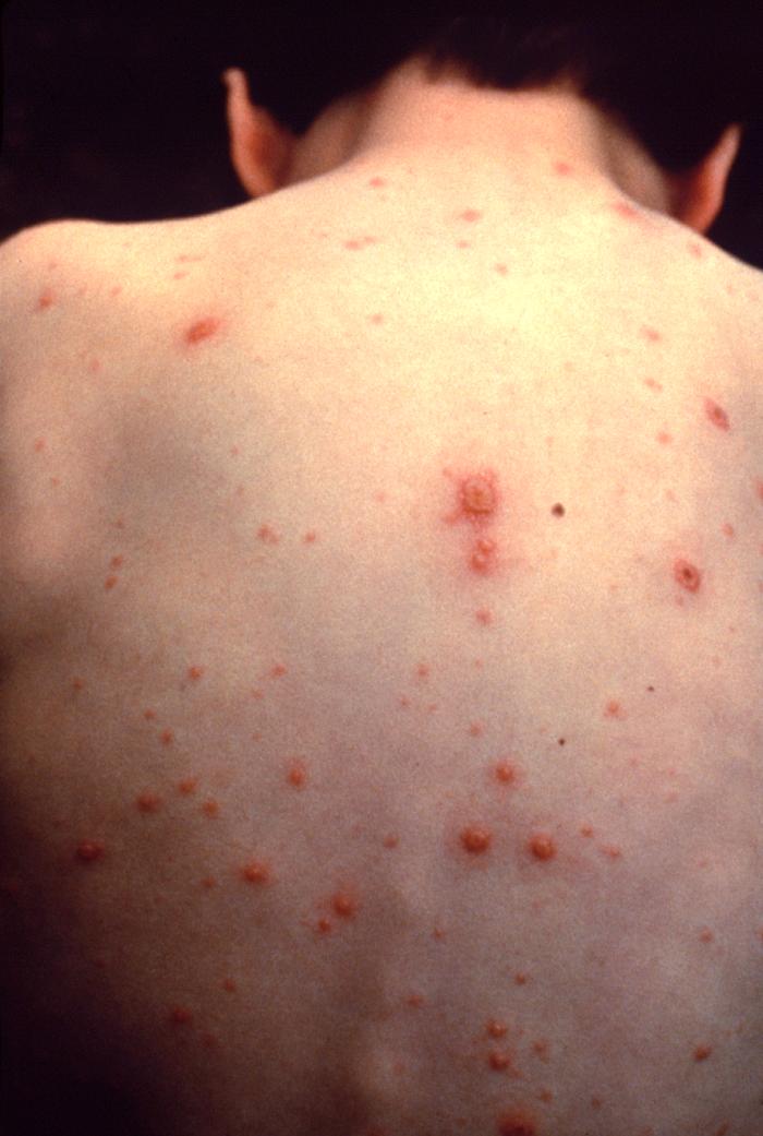 Chickenpox in an unvaccinated child.