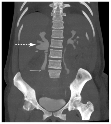 Obstruction of the right ureter (thin arrow) by the enlarged right ovarian vein (thick dashed arrow)[3]