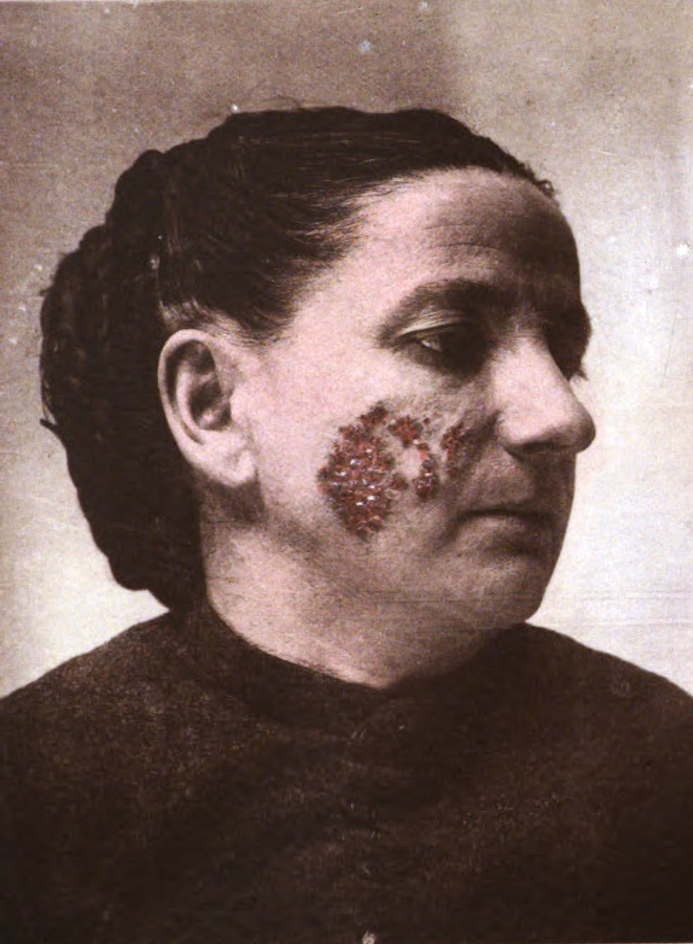 Lupus vulgaris in a woman in the 19th century