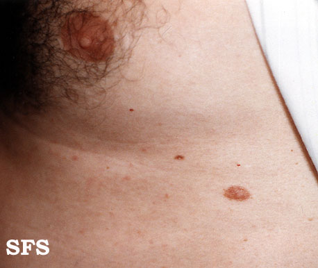 Supernumerary nipples.Adapted from Dermatology Atlas.[4]