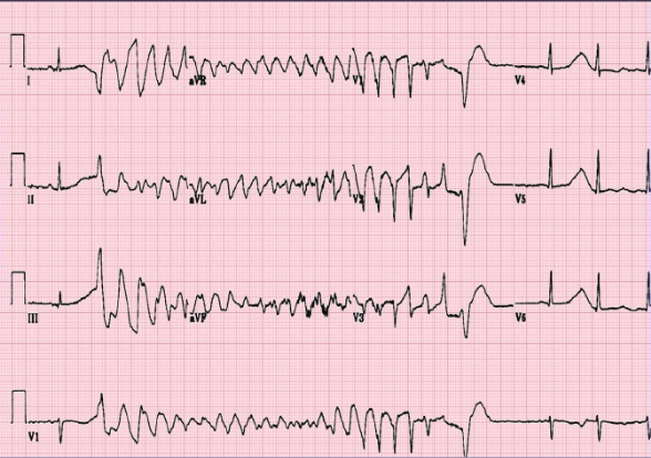 File:Torsade in a patient with Brugada syndrome.PNG
