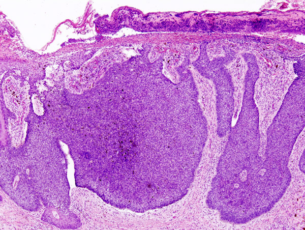 File:Basal cell carcinoma histopathology (1).jpg