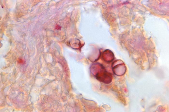 Gridley-stained photomicrograph reveals histopathologic changes, indicative of the chronic fungal disease process known as chromoblastomycosis, or chromomycosis. From Public Health Image Library (PHIL). [3]