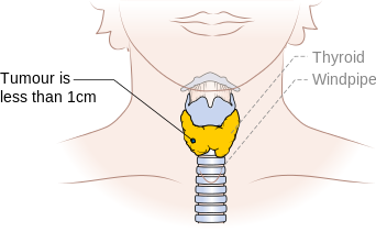 File:Diagram showing stage T1a thyroid cancer CRUK 250.png