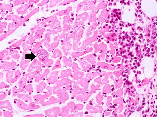 This is a low-power photomicrograph of an H & E stained section from the heart biopsy of this patient. Note the organisms within a myocyte (arrow) and the adjacent inflammatory response.