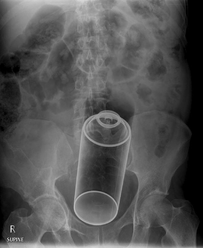 A middle-aged male presented to the emergency department with abdominal discomfort. An abdominal radiograph was performed as shown. There is no evidence of perforation or obstruction. The patient was taken to operating room within 12 hours of presentation, with consent for colostomy. Under general anaesthesia in the lithotomy position, dilatation of anal sphincter was performed and per rectum retrieval successful. These patients typically have a delayed presentation to the emergency department because of embarrassment and after multiple attempts at self removal. Respect for their privacy is a key factor in the patient’s care plan. ED physicians need to decide if removal of foreign body can be performed in the emergency department or surgical team to be notified. Operating room procedures include anal dilatation under GA, transrectal manipulation, bimanual palpation if necessary and withdrawal of foreign body. Laparotomy or laparoscopy are occasionally necessary. (Image courtesy of Andrew Roshan)