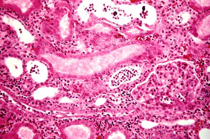 This high-power photomicrograph demonstrates the cellular infiltrate within the interstitium and cells within the renal tubules.