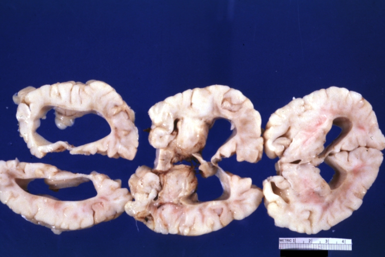 Brain: Hydrocephalus Secondary To Arnold Chiari Malformation: Gross fixed tissue three coronal sections cerebral hemispheres
