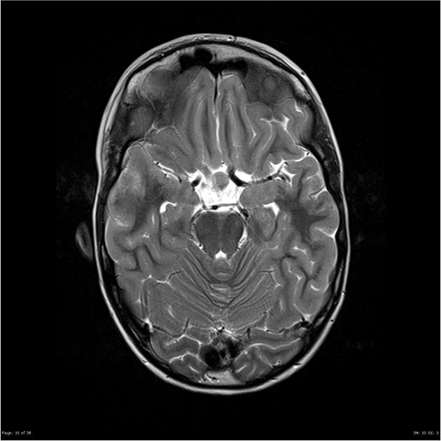 MRI showing Axial T2 image of pineal germinoma[7]
